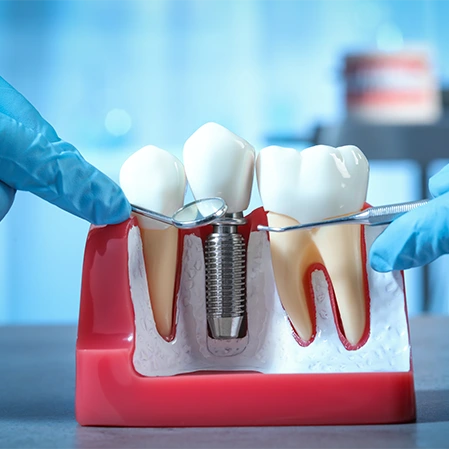 Dental Implant Model
